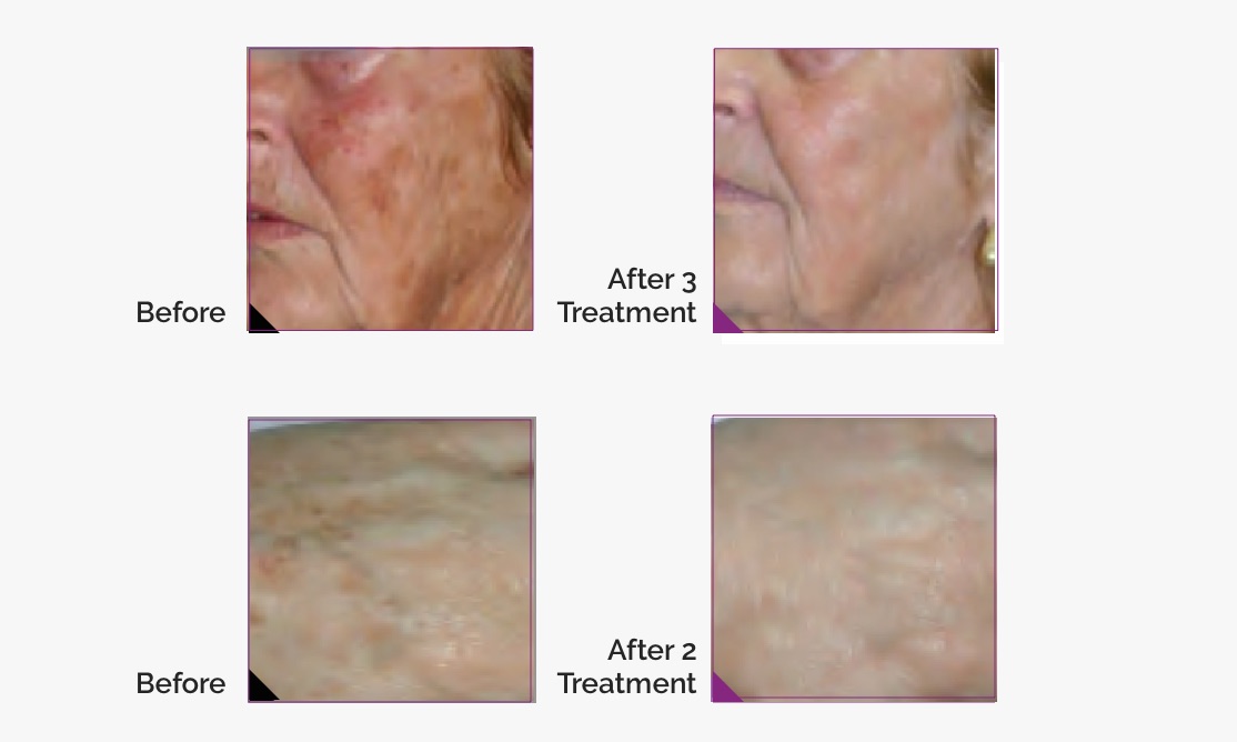 pigmentation