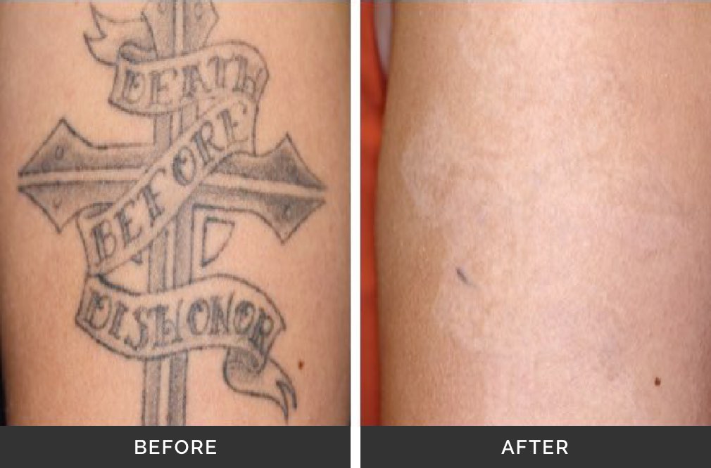 Tattoo Removal