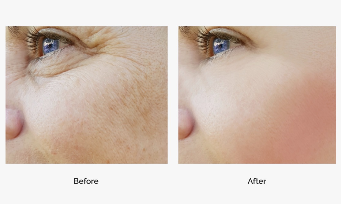 wrinkle-before-after